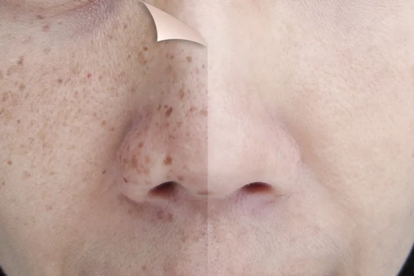 RF Microneedling