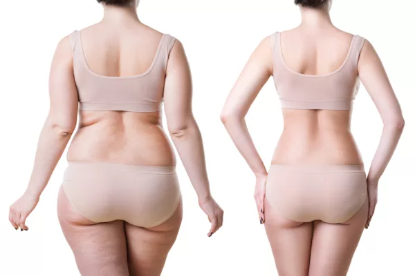 LIPOCel Fat Reduction