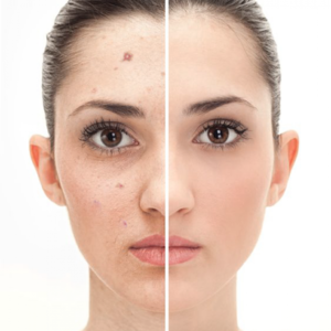 Lamprobe Treatment
