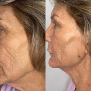 PDO Threads Treatment in Scottsdale