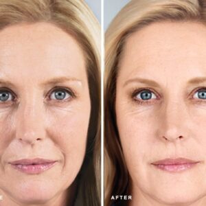 Sculptra Treatment