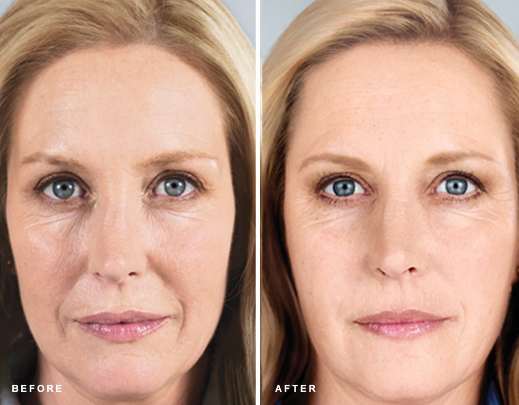Sculptra Treatment