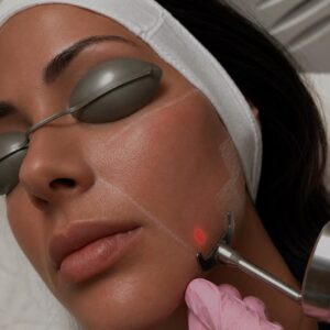 Fractional Laser Treatment