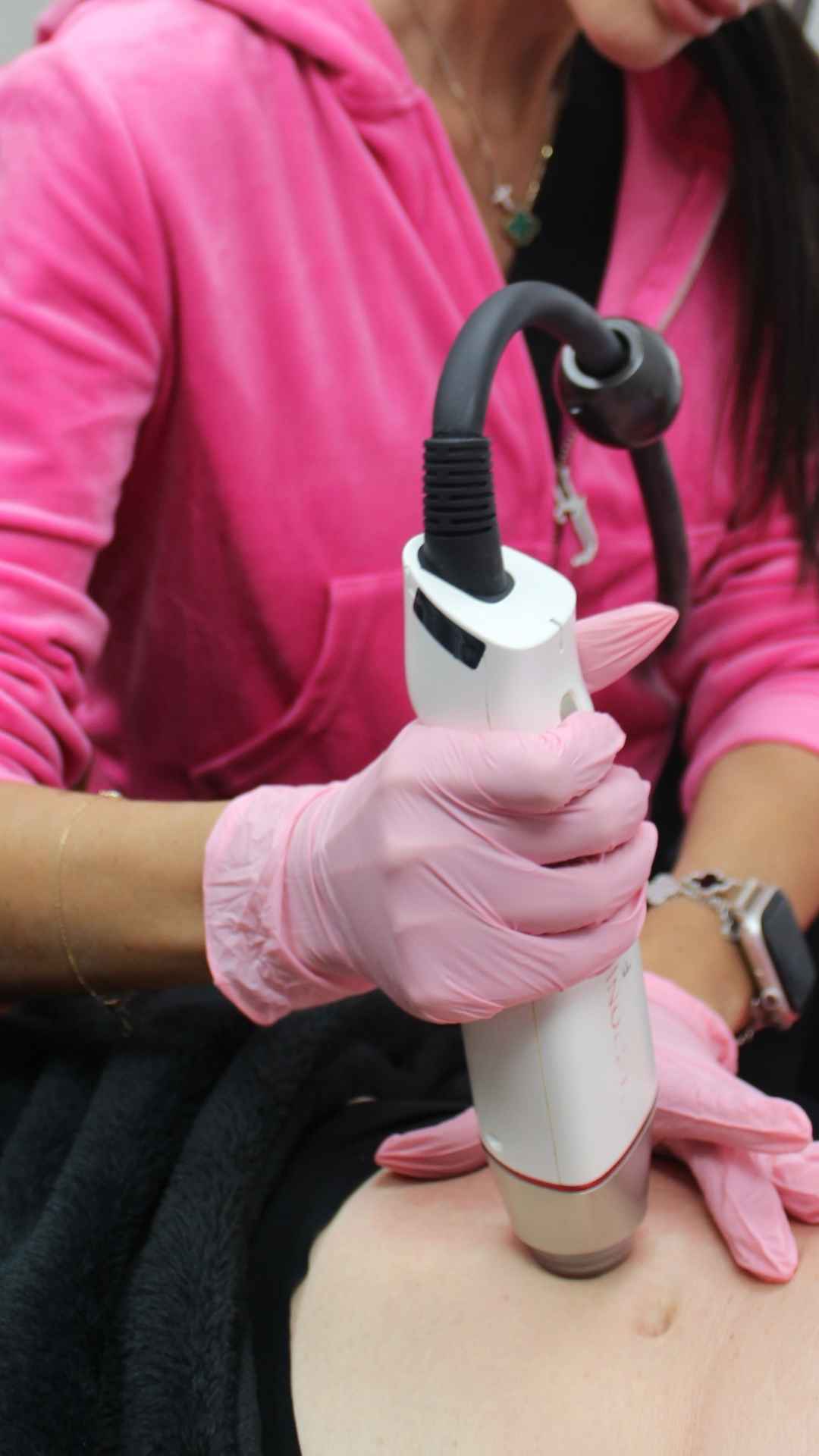 RF Microneedling treatment in Scottsdale